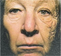 envelhecimento precoce